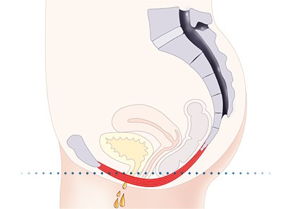 Pelvic-Floor Muscle Repair 5 Pelvic floor muscles Dudley