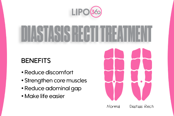 Revolutionising Muscle Repair: The Power of LIPO360 Body Sculpt Post-Injury 5 diastasis recti treatment Dudley