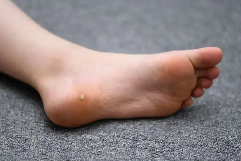 Cryotherapy For Warts And Also Verrucas 2 Image of verruca on the bottom of the foot that able to be treated with Cryotherapy Dudley
