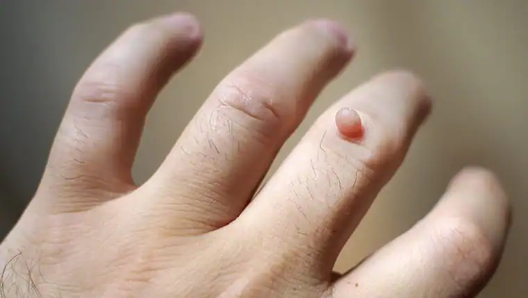 Cryotherapy For Warts And Also Verrucas 1 Image of blemish that Cryotherapy Dudley can remove with Lipo 360.
